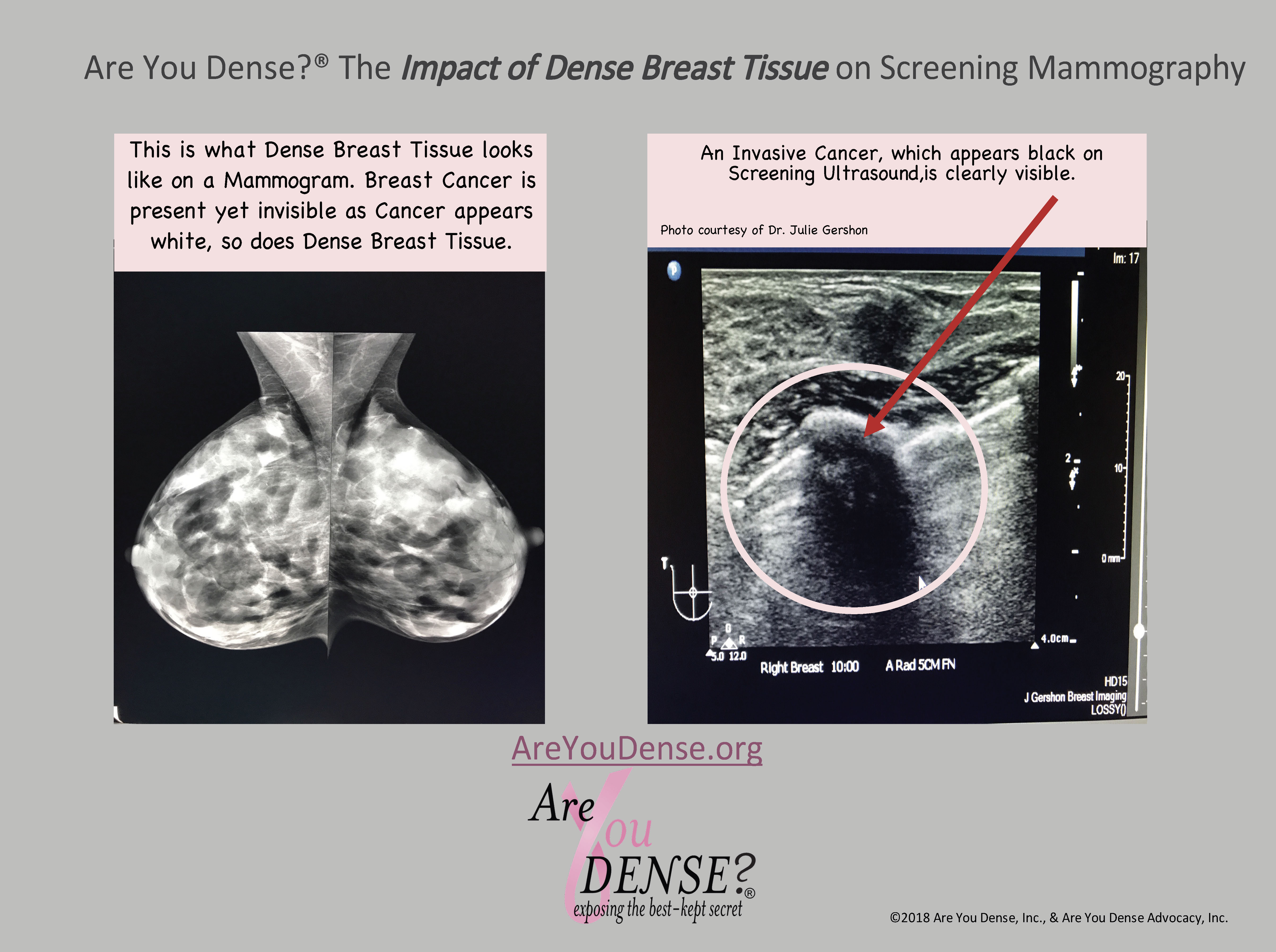IMPACT DENSE on mammogramFINAL.jpg